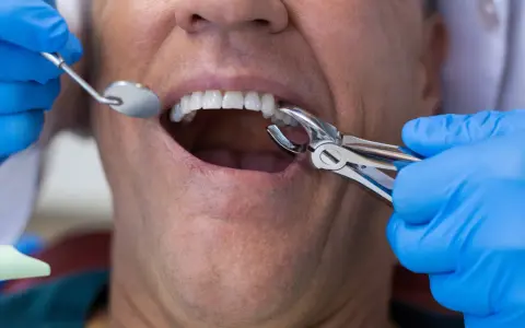 Ból po wyrwaniu zęba: ile trwa, co normą i kiedy do dentysty?