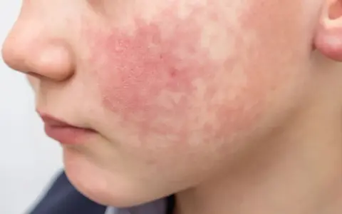 Rumień zakaźny w przedszkolu: Kiedy powrót? Jasne zasady