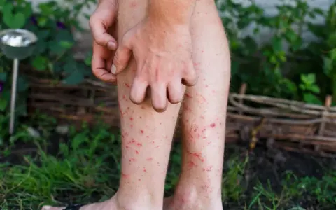 En person kliar sina ben som är täckta av röda prickar, troligen stress eksem.