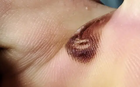 Nahaufnahme einer verbrannten Hautstelle, die wie eine Wasserblase aussieht. Die Behandlung dieser Verletzung ist wichtig.