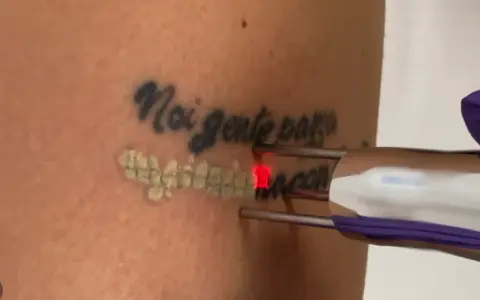 Rimozione tatuaggio con laser: un fascio rosso illumina la pelle mentre si procede a togliere il disegno.
