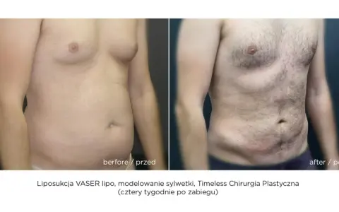 Liposukcja: Modelowanie sylwetki, nie odchudzanie. Poznaj fakty!
