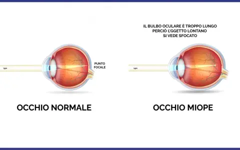 Confronto tra occhio normale e occhio miope. La miopia d'indice è causata da un bulbo oculare troppo lungo, che sfoca gli oggetti lontani.