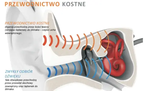 Ilustracja porównuje przewodnictwo kostne (drgania przez kości twarzy do ślimaka) ze zwykłym odbiorem dźwięku.