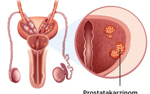 Was wird bei der Prostatakrebs Vorsorge gemacht? Wichtige Schritte erklärt