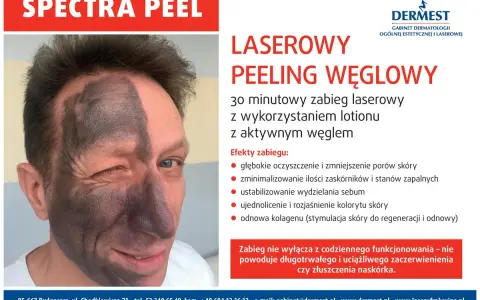 Przed i po laserowym peelingu węglowym: połowa twarzy pokryta czarną maską węglową, druga połowa czysta. Efekt odświeżenia i oczyszczenia.