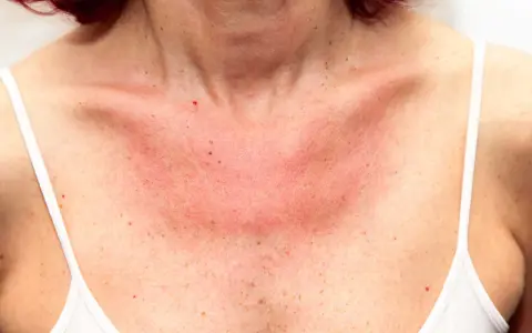 Här ser du hur soleksem kan se ut: röd, irriterad hud på bröstet och halsen, med små prickar.