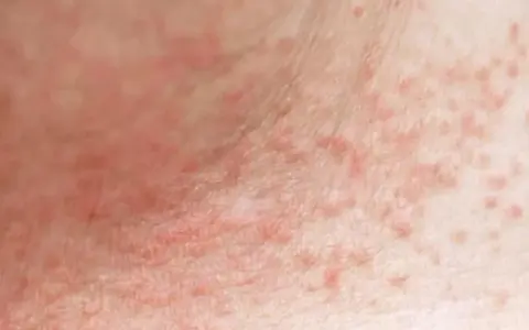 Piel con erupción de pequeños granos rojos, posiblemente por sudor.