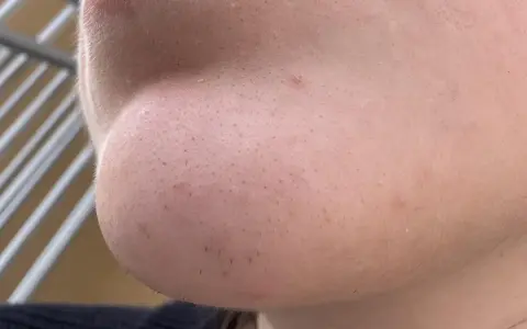 Primo piano del mento con pori visibili e alcuni punti neri. Si intravedono anche peli sottili e una piccola imperfezione.