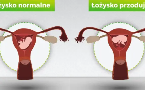 Porównanie: łożysko normalne vs łożysko przodujące. Na obrazku widać macicę z płodem. W przypadku łożyska przodującego, łożysko znajduje się na przedniej ścianie macicy.