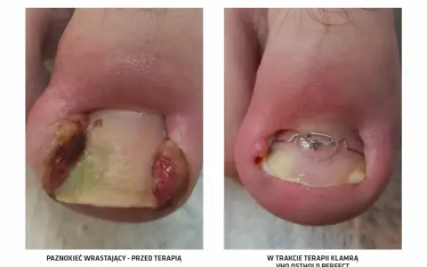 Przed i w trakcie terapii wrastającego paznokcia klamrą VHO Osthold Perfect. Tribiotic na wrastający paznokieć może pomóc w leczeniu.