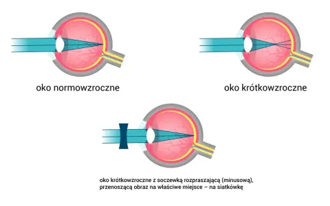 Ilustracja oka: normowzroczne, krótkowzroczne i krótkowzroczne z soczewką korygującą.