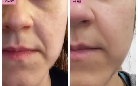 Comparaison avant/après : la peau semble plus lisse et les rides d'expression moins marquées grâce au bakuchiol.