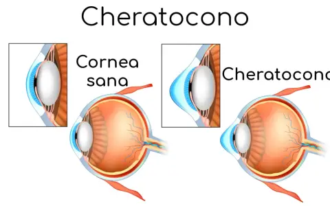 Confronto tra cornea sana e cheratocono. Anche a 50 anni, il cheratocono può alterare la forma dell'occhio.