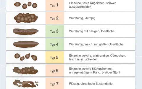 Typ 6 zeigt einzelne weiche Klümpchen mit unregelmäßigem Rand, was auf breiigen Stuhlgang hindeutet. Die Abbildung vergleicht verschiedene Stuhlformen.