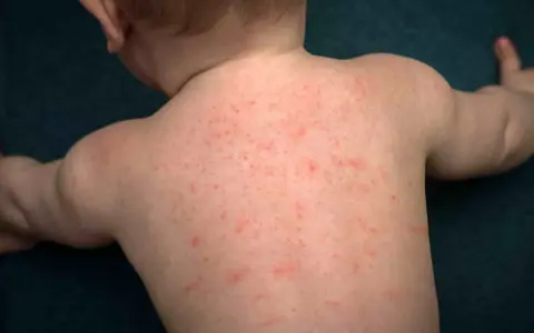 Schiena di neonato con eruzione cutanea rossa diffusa, forse dovuta a sudorina sulla pelle.