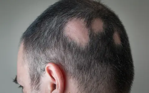 Haaransatz mit kahlen Stellen, die wie Pickel auf der Kopfhaut aussehen.