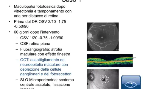 Caso 1: Maculopatia post-vitrectomia con bolla d'aria. Immagini OCT e SLO mostrano assottigliamento neuroepiteliale e scotoma.