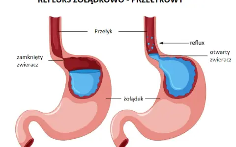 Ilustracja pokazuje refluks żołądkowo-przełykowy. Po lewej zamknięty zwieracz, po prawej otwarty, powodujący cofanie się treści żołądkowej do przełyku. Kawa może nasilać ten problem.