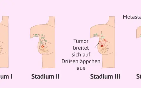 Illustrationen zeigen Stadien von Brustkrebs. Frühe Symptome wie ein Tumor werden sichtbar, bevor er sich ausbreitet. Spätere Stadien zeigen Metastasen.