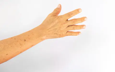 Bras avec des taches solaires, marques du temps et du soleil sur la peau.