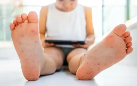 Pies de niño con erupción roja, posible síntoma de rubeola.