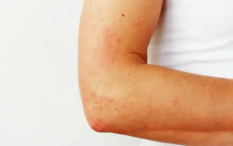 Plaques rouges et irritées sur le coude, signe d'eczéma.