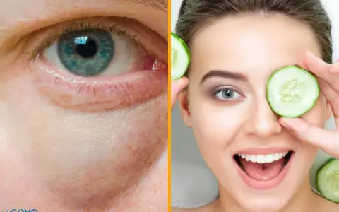 Ojo con bolsas y ojeras, y una mujer sonriente con rodajas de pepino, mostrando remedios caseros para las bolsas en los ojos.