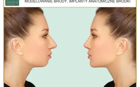 Przed i po zabiegu modelowania brody. Genioplastyka poprawiająca profil twarzy.