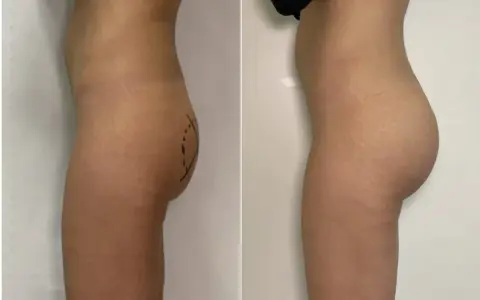 Prima e dopo gluteoplastica mini invasiva: un aumento del volume e della proiezione dei glutei, con un risultato naturale.