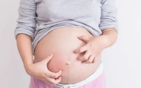 Kobieta w ciąży drapie brzuch z powodu swędzenia skóry.