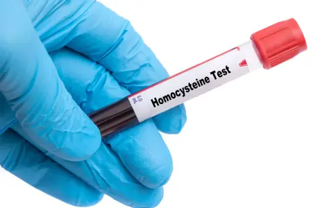 Rękawiczka z niebieskiej gumy trzyma probówkę z krwią do badania na obecność homocysteiny, która może wpływać na poziom cholesterolu.