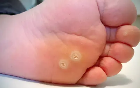 Gros plan sur la plante d'un pied, montrant deux verrues plantaires qui ne partent pas, avec une peau calleuse autour.