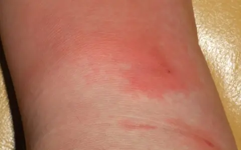 Pelle arrossata e infiammata sulla gamba, con segni di erisipela.
