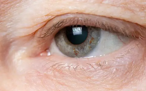 Occhio con palpebra leggermente gonfia, segno di edema oculare da stress. La pelle appare stanca, con sottili rughe e qualche ciglia spezzata.