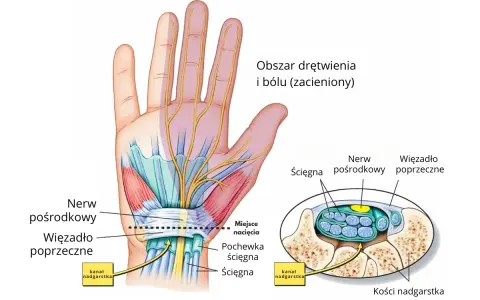 Ilustracja anatomiczna dłoni i nadgarstka z zaznaczonym nerwem pośrodkowym i więzadłem poprzecznym.