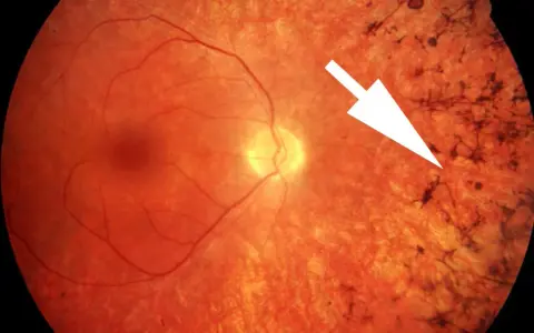 Retinite pigmentosa: sintomi visibili come depositi scuri sulla retina, indicati da una freccia bianca.