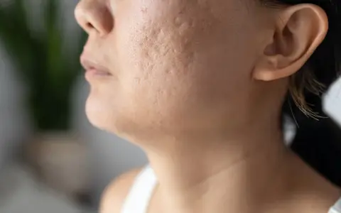 Primer plano de una mejilla con marcas de acné, mostrando la textura de la piel y la búsqueda de soluciones sobre como quitar marcas de acne.