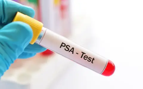 Blauer Handschuh hält Röhrchen für PSA-Test. Der PSA-Wert ist normal, was für die Gesundheit spricht.