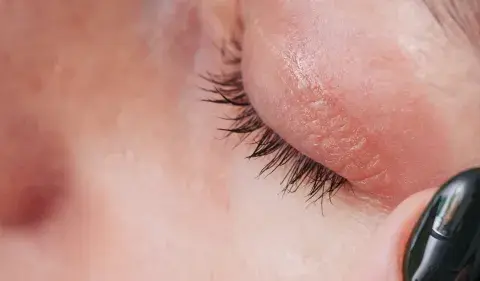 Nahaufnahme eines Auges mit roten Augenlidern, die auf eine Mangelerscheinung hindeuten. Eine dunkle Nagelspitze berührt sanft die Haut.