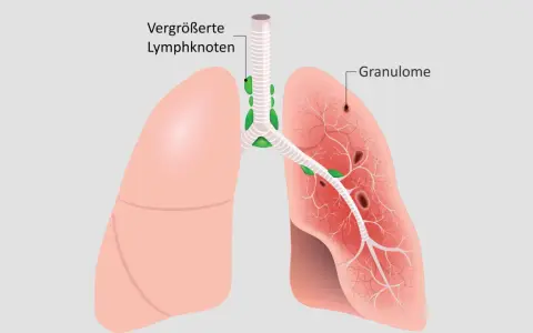 Lunge mit vergrößerten Lymphknoten und Granulomen, typische Sarkoidose-Symptome.