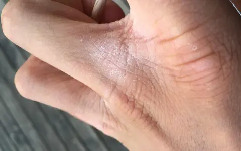 När huden är torr mellan fingrarna kan det kännas obekvämt. Här syns en närbild på en hand med torr hud och lite vita flingor.