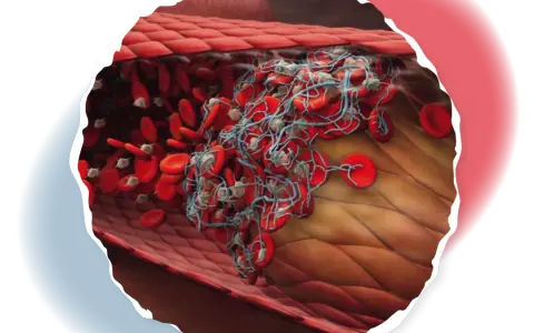 Polycythaemia vera symptome: Erkennen Sie die versteckten Warnsignale