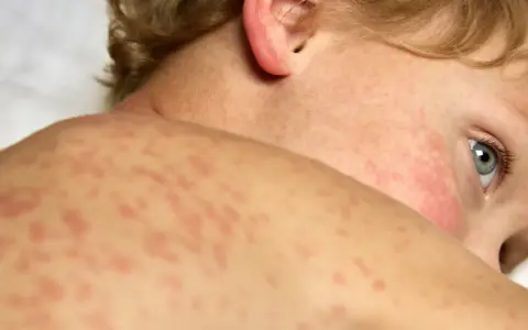 Skóra dziecka pokryta jest czerwonymi plamkami, które mogą świadczyć o różyczce. Widać fragment oka i ucha malucha.