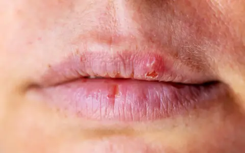 Labbra secche e screpolate, con piccole lesioni. Potrebbe essere un segnale che il fegato ha bisogno di attenzione.