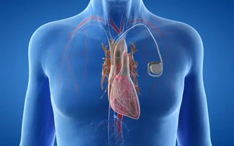 Anatomical illustration showing a human heart with a rozrusznik serca implanted.