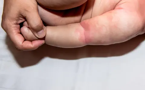 Dłoń rodzica delikatnie obejmuje ramię niemowlaka, na którym widoczna jest szorstka skóra, zaczerwieniona i lekko podrażniona.