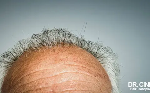 Gros plan sur le front d'un homme aux cheveux gris clairsemés. La vitamine D, source de bienfaits pour les cheveux, est essentielle pour leur santé.