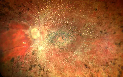 Retina con pigmentazione irregolare e vasi sanguigni, indicativa di amaurosi congenita di Leber. Ricerca di nuove cure in corso.
