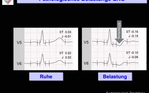 Vergleich von EKG-Aufzeichnungen in Ruhe und unter Belastung. Das Belastungs-EKG zeigt eine ST-Senkung, was auf pathologische Veränderungen hinweist.